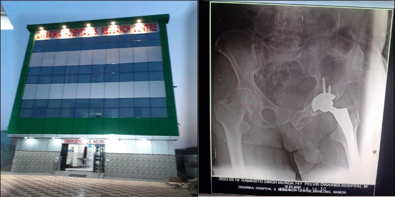 Total hip replacement was successfully done at Dwarka Hospital.
